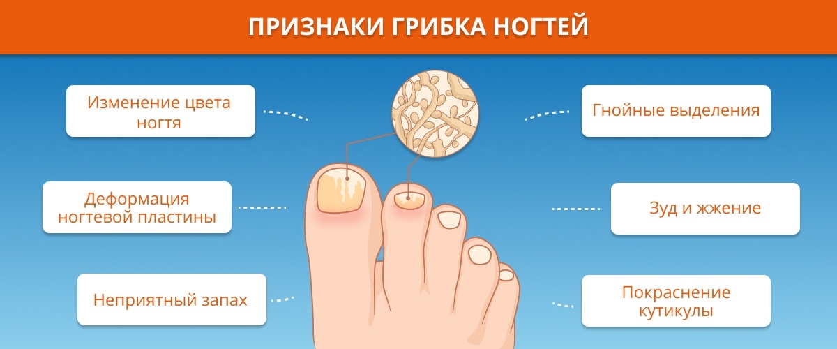 Начальная стадия грибка ногтей на руках и ногах: симптомы (фото) и лечение