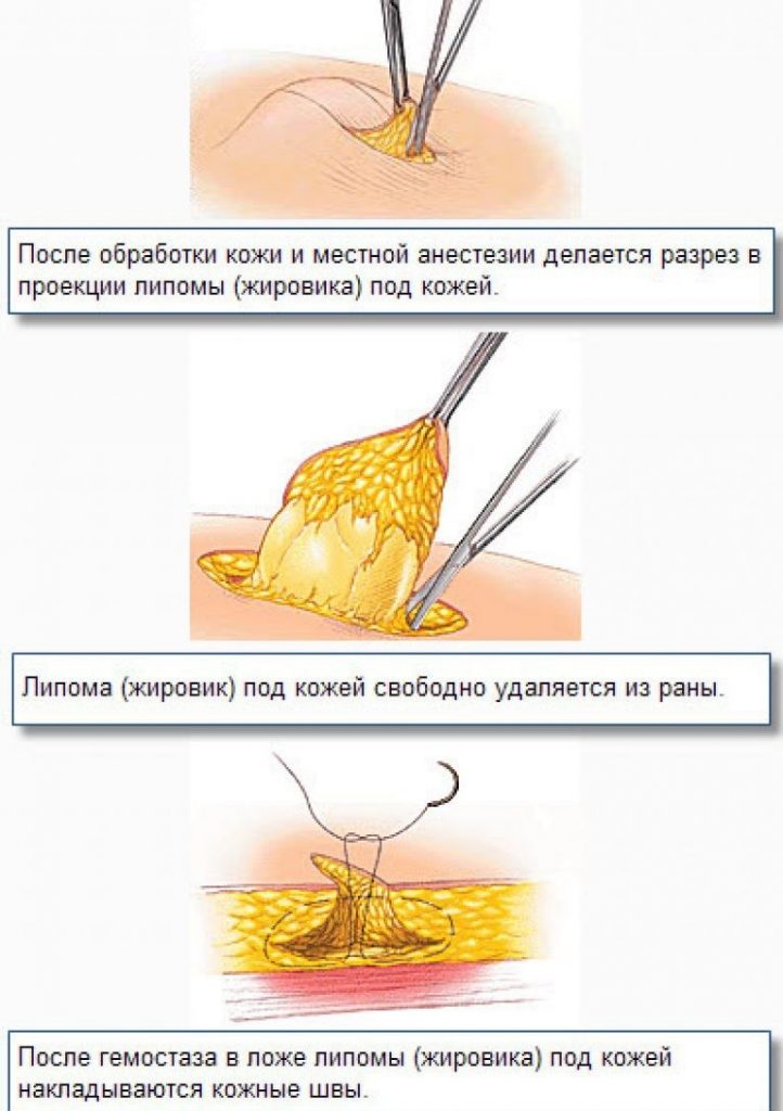 Как убрать жировики на лице с помощью домашних рецептов?