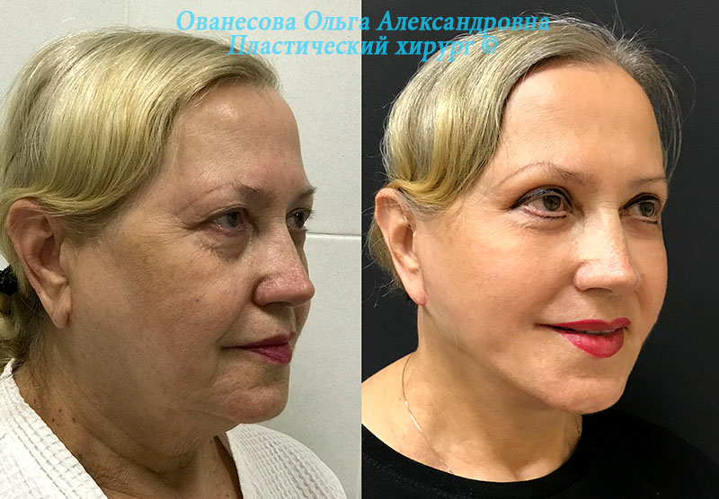 Круговая подтяжка лица (фейслифтинг)