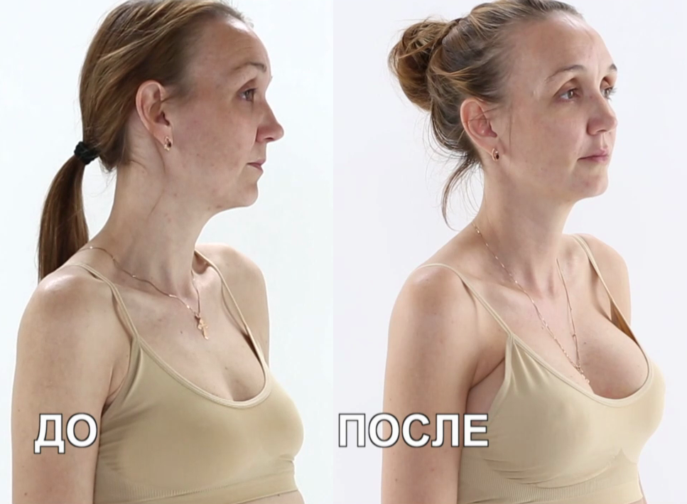 Подтяжка груди: фото до и после, виды - лазерная, вертикальная, эндоскопическая и другие, а также как называется и как делают операцию?