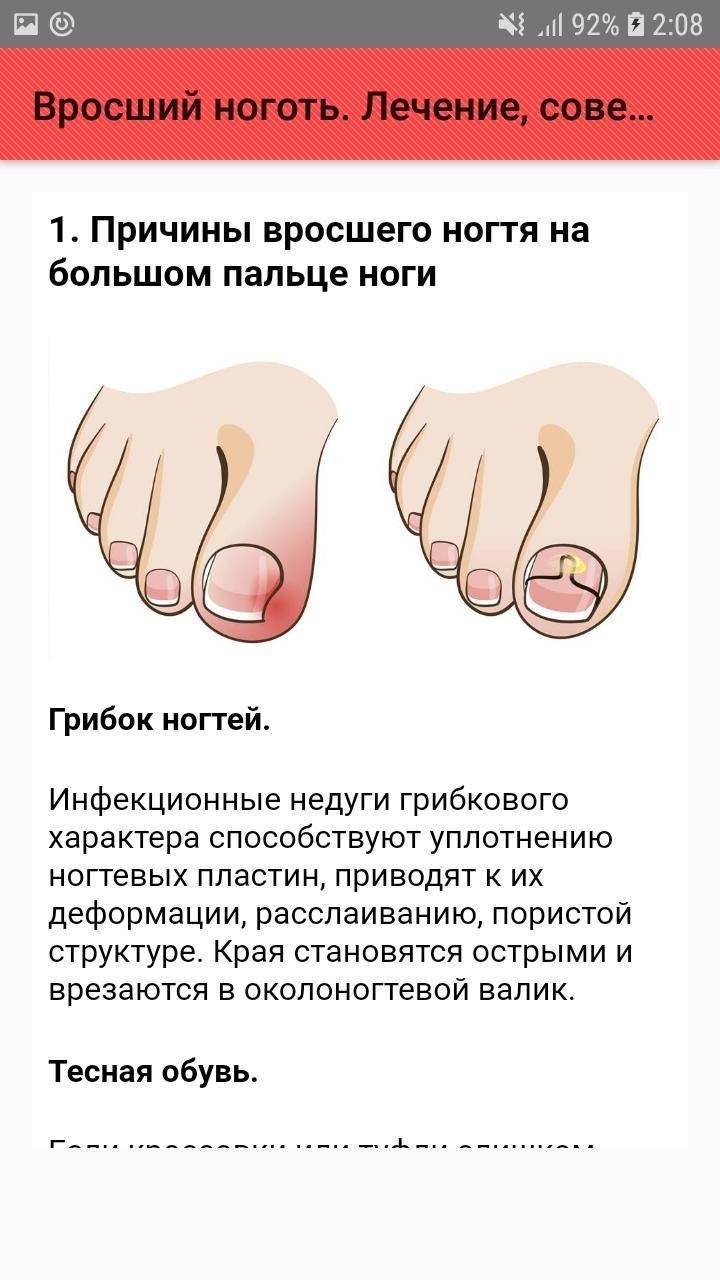 Как избавиться от вросших ногтей