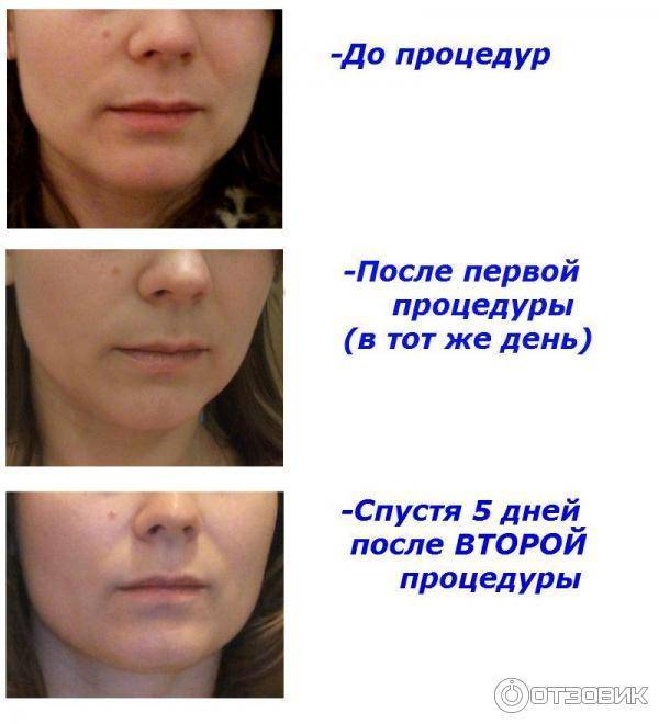 Рф лифтинг [rf подтяжка] – волнующие вопросы и ответы на них