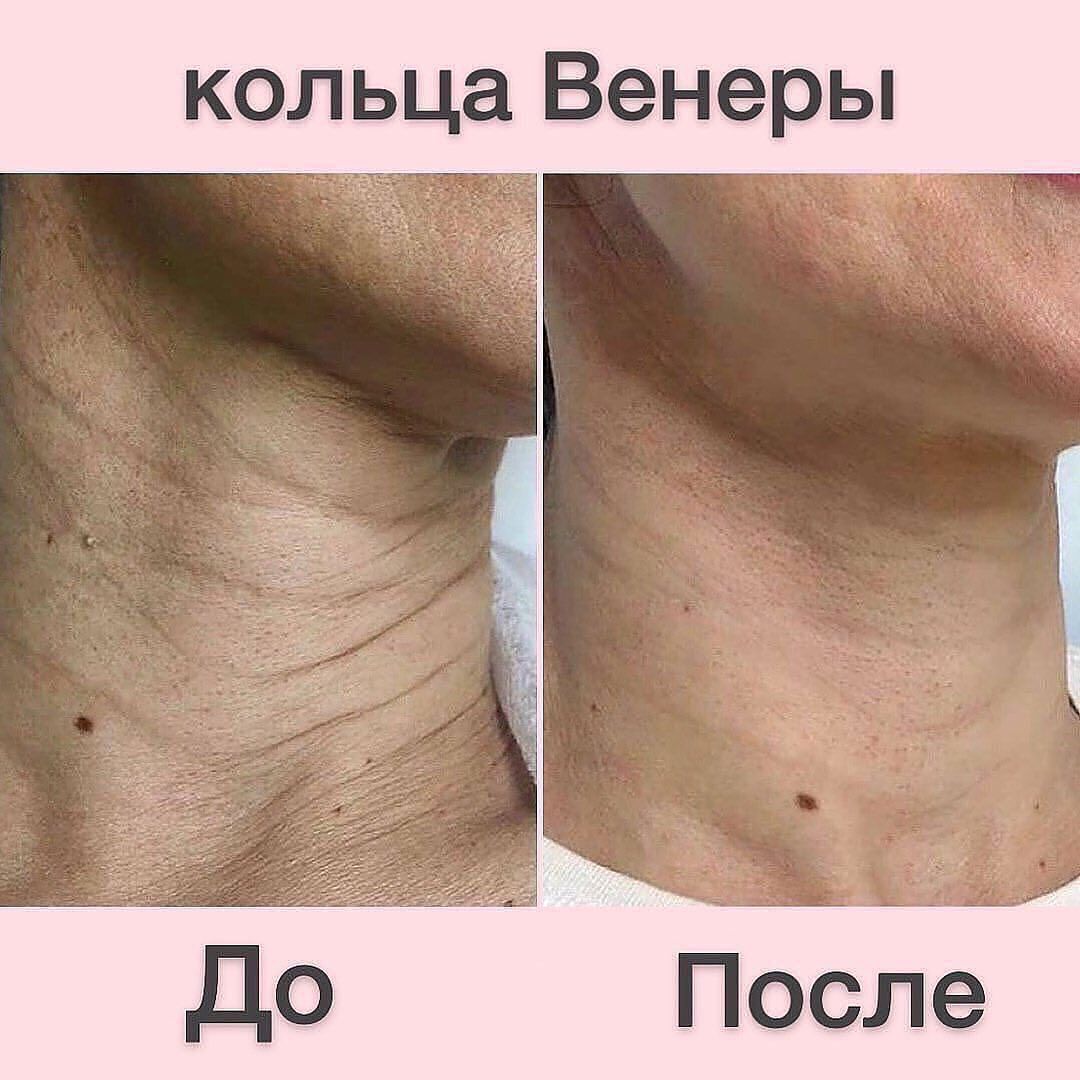 Кольца венеры на шее – топ-методы устранения (2021)
