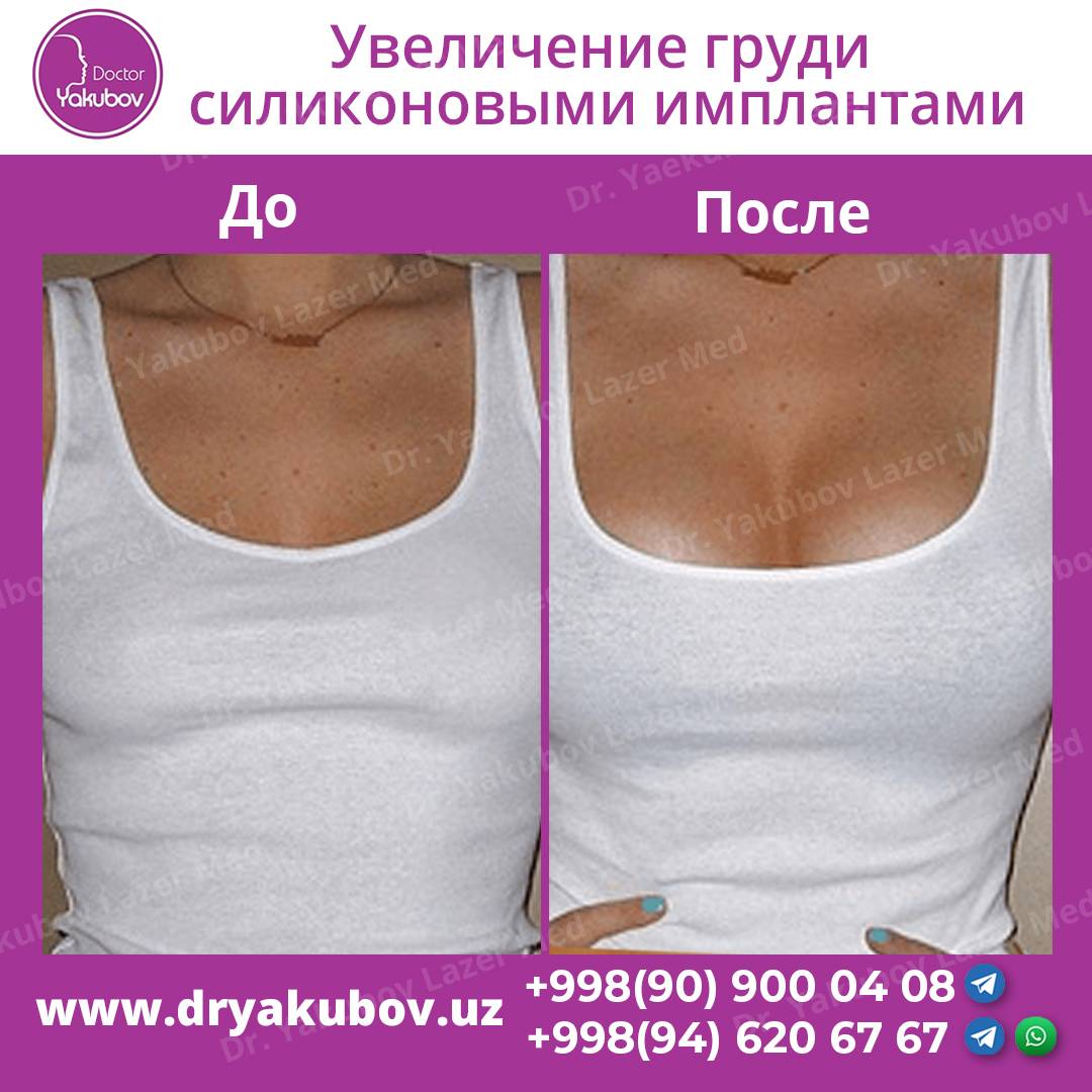 Виды имплантов для маммопластики: какие выбрать? - всё о маммопластике