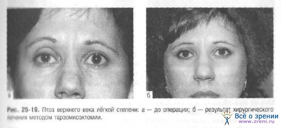 Птоз - виды, причины, симптомы, методы диагностики и лечения
