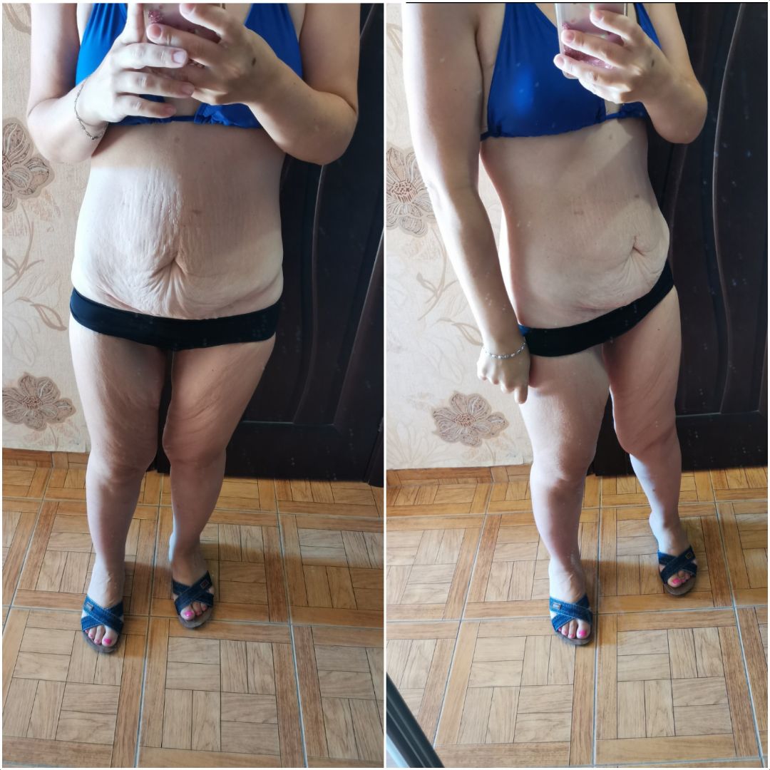 9 способов подтянуть кожу лица после похудения в домашних условиях