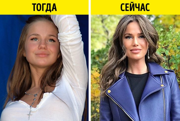 Алекса: контурная пластика губ и ринопластика певицы, фото до и после