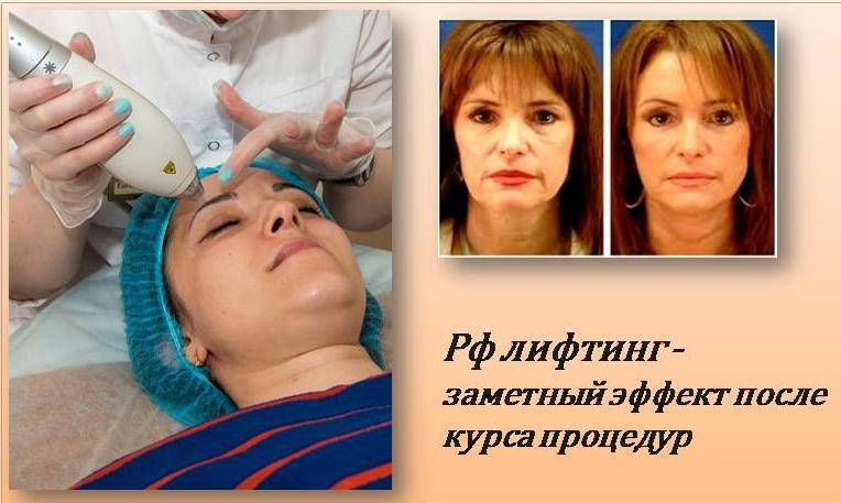 Что такое rf лифтинг: показания и противопоказания