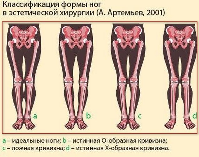 Ноги колесом (кривые) у девушки. как исправить