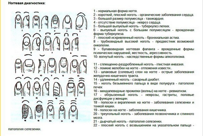 Как определить болезнь по ногтям