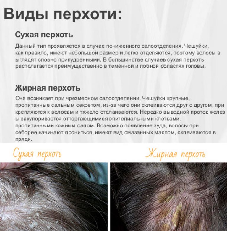Трубчатая перхоть, причины и симптомы, лечение