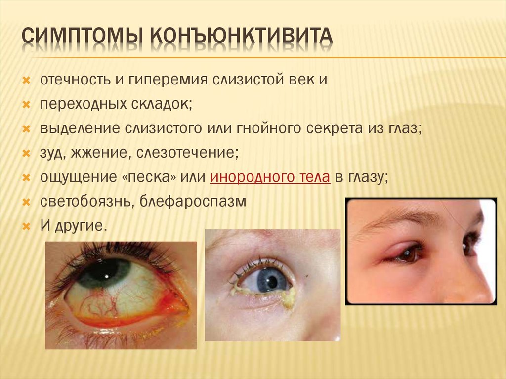 У ребенка гноятся глаза: 3 вероятных причины-заболевания, методы лечения и профилактика