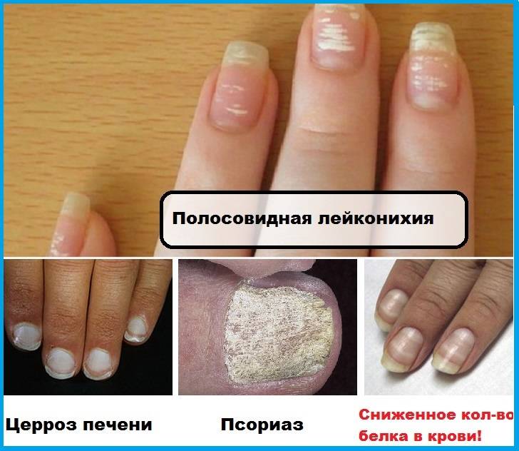 Почему на большом пальце ноги ноготь ребристый. о неприятном… неровные ногти на ногах: причина – здоровье | маникюр
