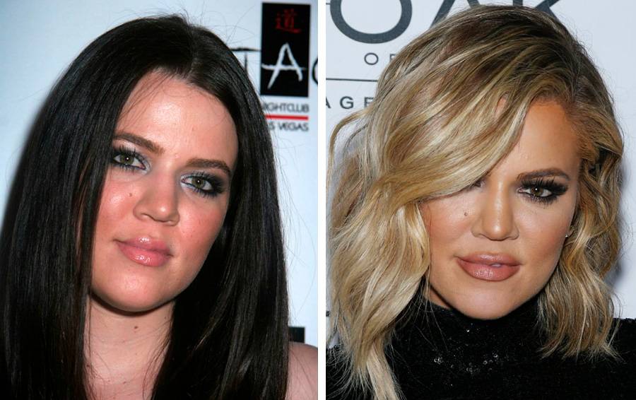 Все пластические операции кайли дженнер | фото до и после