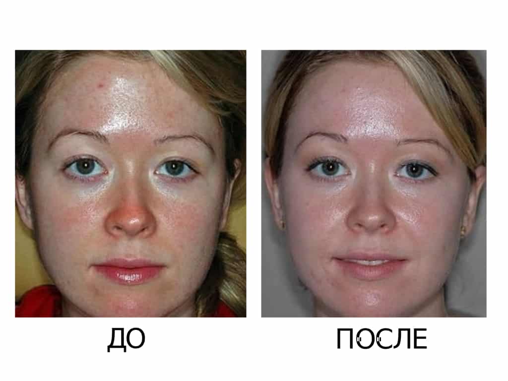 Пилинг джесснера – один из самых популярных методов омоложения