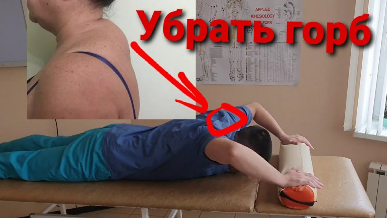 Как убрать холку на шее сзади, чтобы  избавиться от горбика на шее навсегда