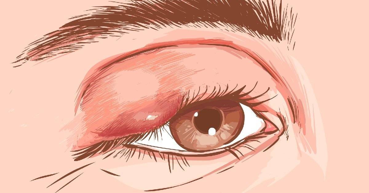 Ячмень на глазу: причины, симптомы и лечение