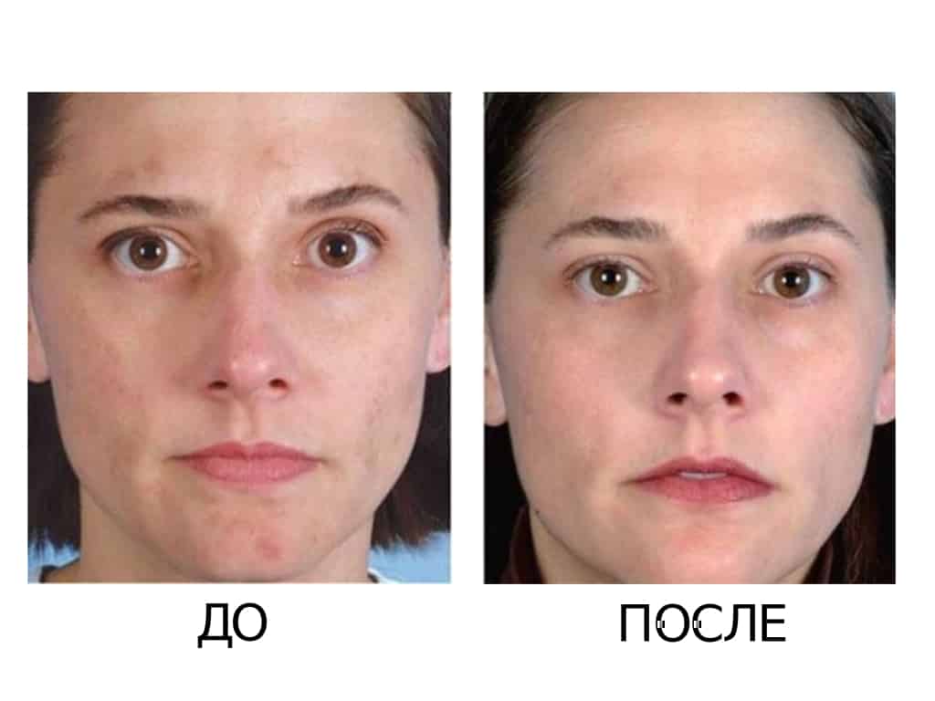 Миндальный пилинг