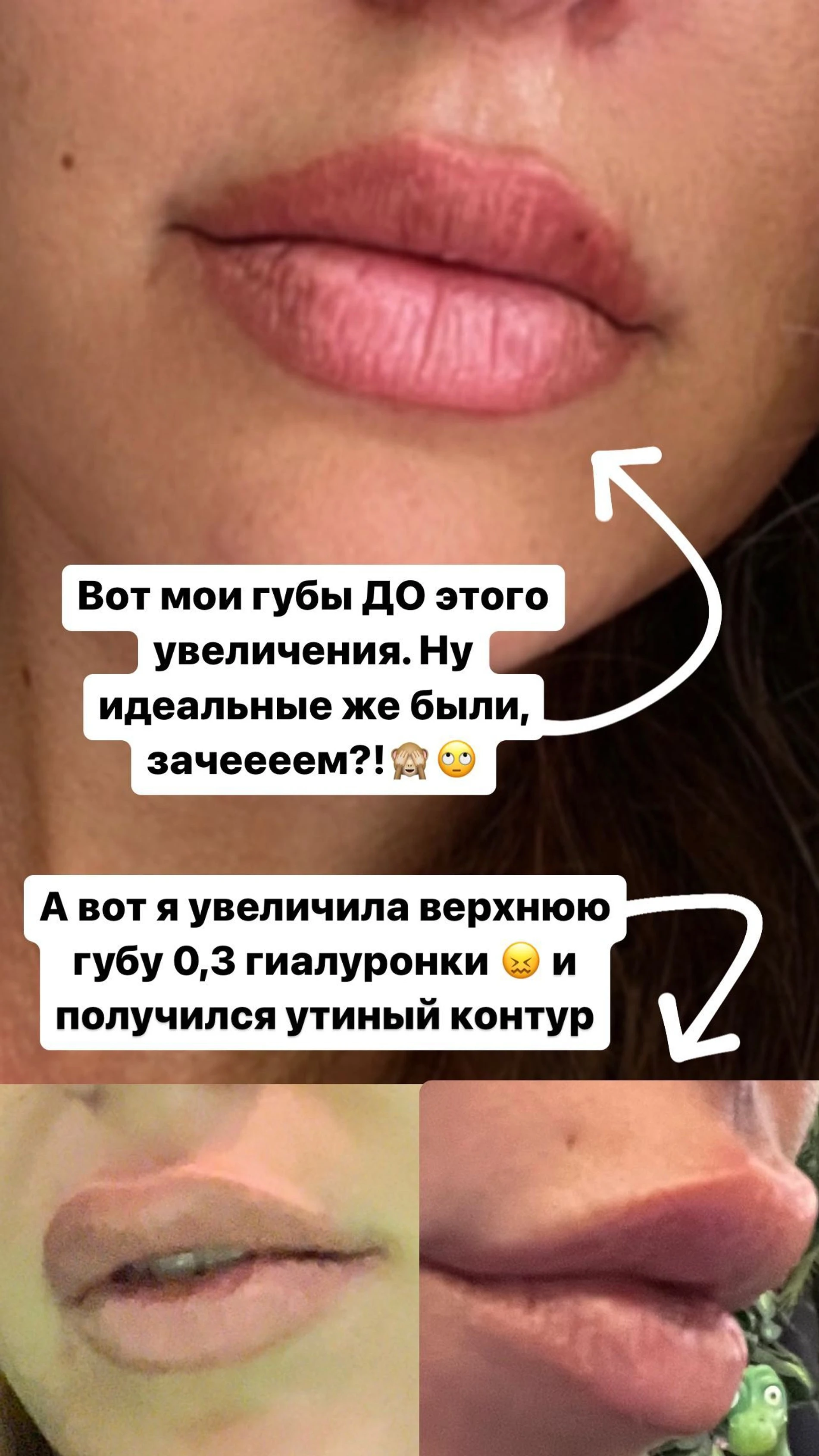 Утиные истории: как создать естественную форму губ и избежать неудач?