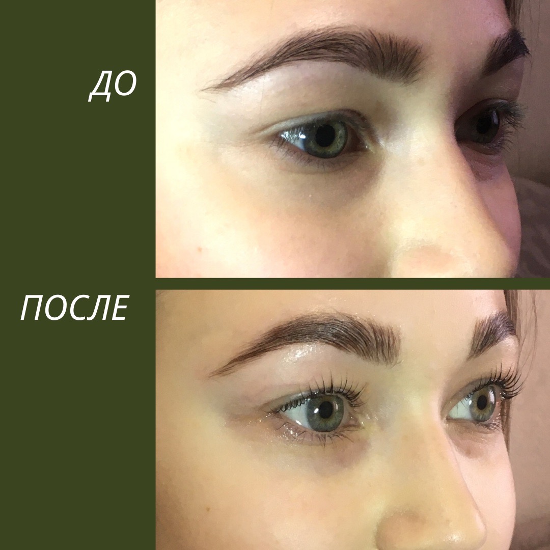 Всё, что необходимо знать о том, как поднять брови ботоксом