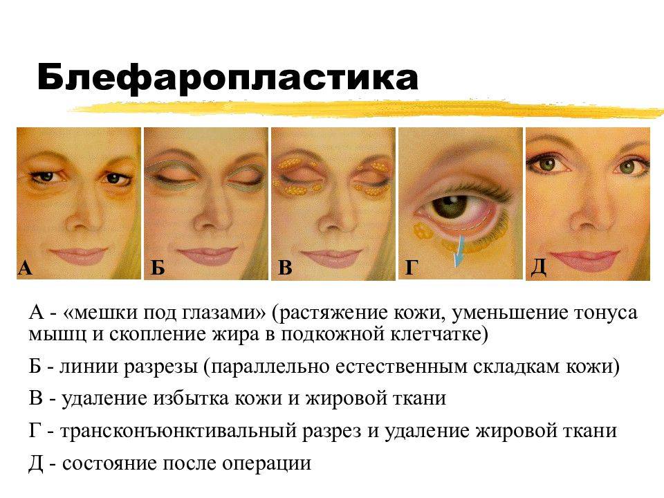 Как выглядят опухшие мешки под глазами: от чего появляется постоянный отек у женщин, почему отекают веки, из-за каких причин опухает лицо, образуются одутловатости и что это означает