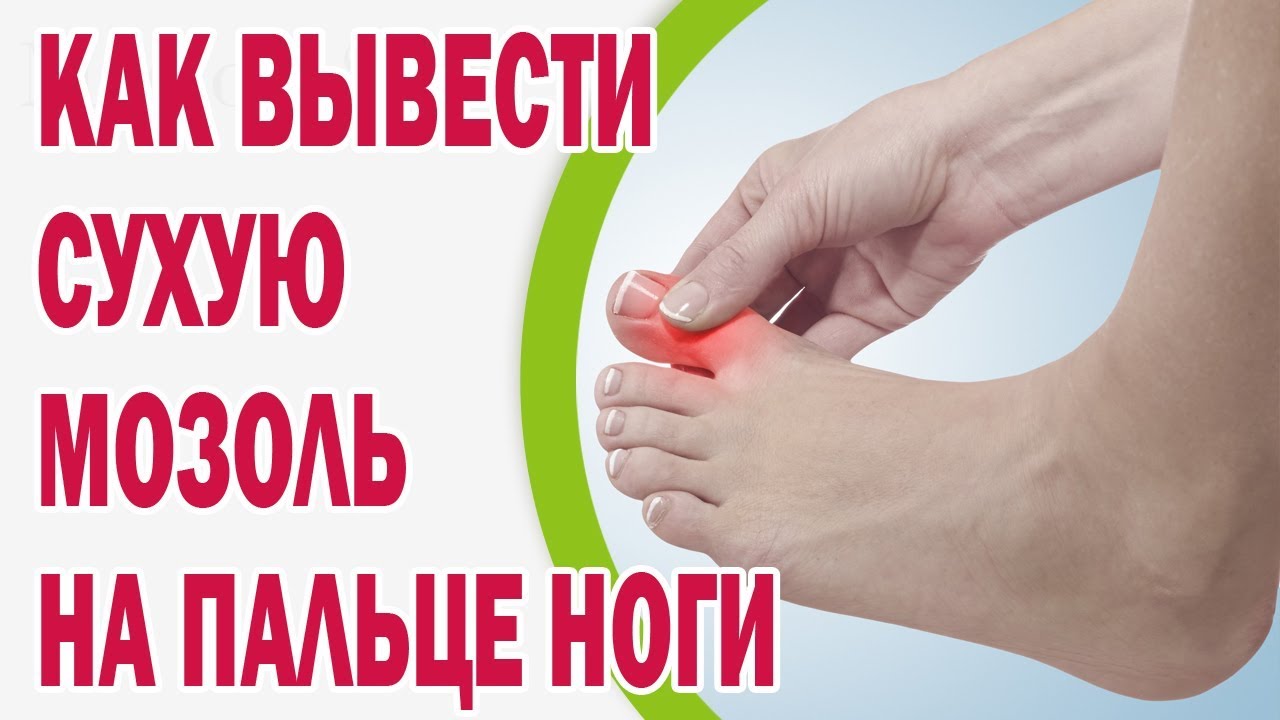 Убираем мозоли на ладонях: действенное лечение | musizmp3.ru