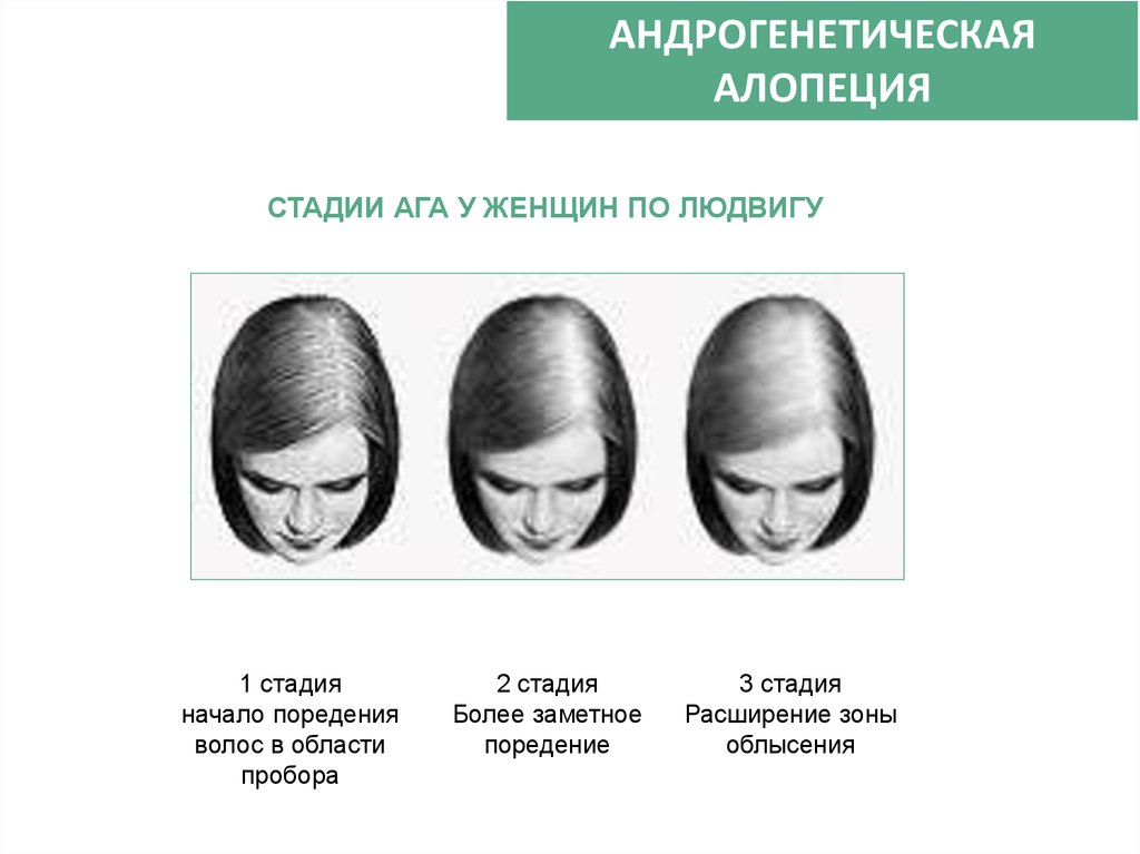 Алопеция (облысение, выпадение волос). причины, виды, лечение и профилактика патологии