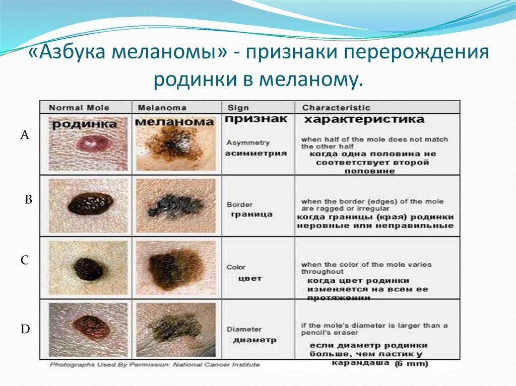 Удаление родинок лазером — есть ли преимущества в лазерном удалении родинок? * клиника диана в санкт-петербурге