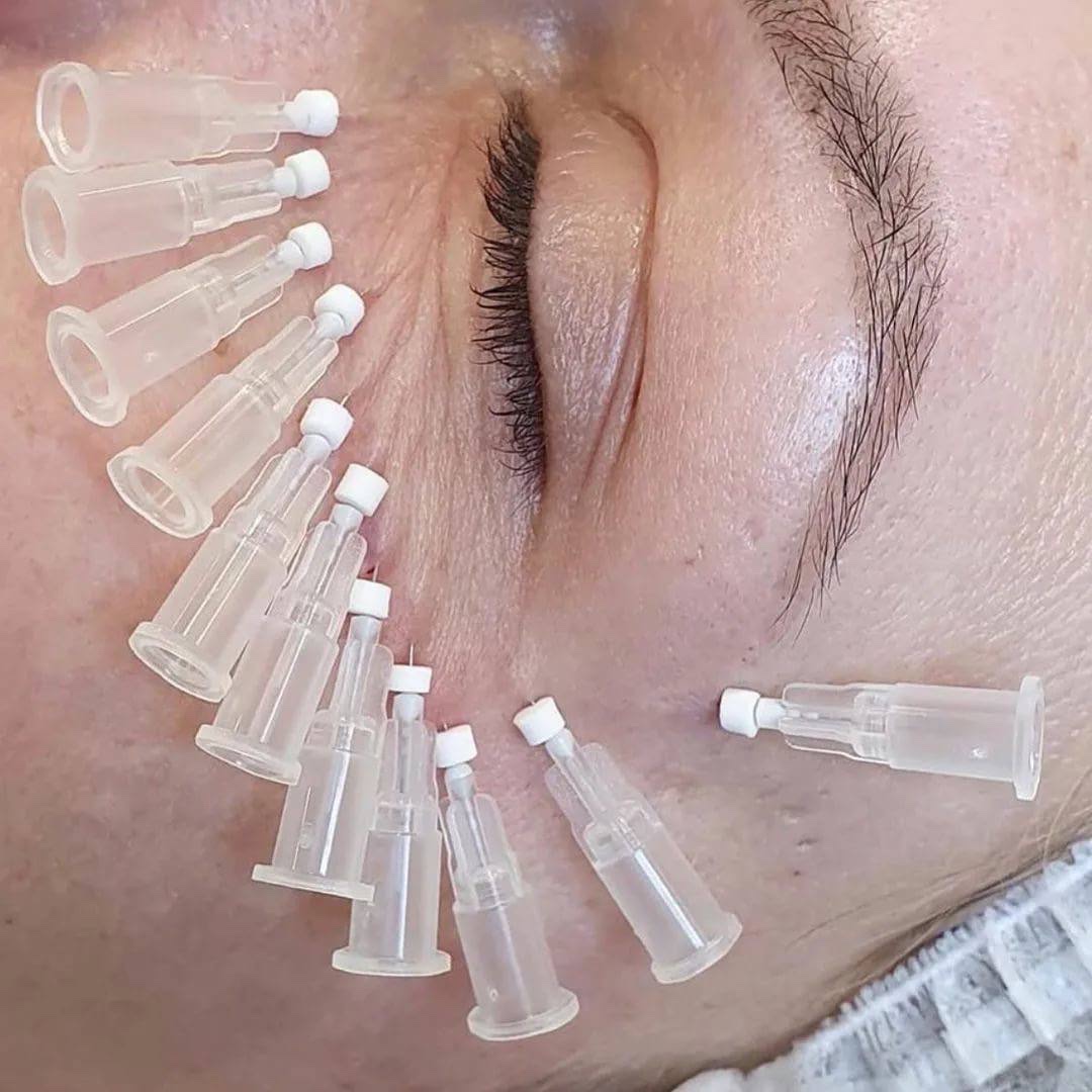 Нитевой лифтинг — какие нити уже устарели, почему результат подтяжки бывает разным и сколько держится — центр эстетической медицины