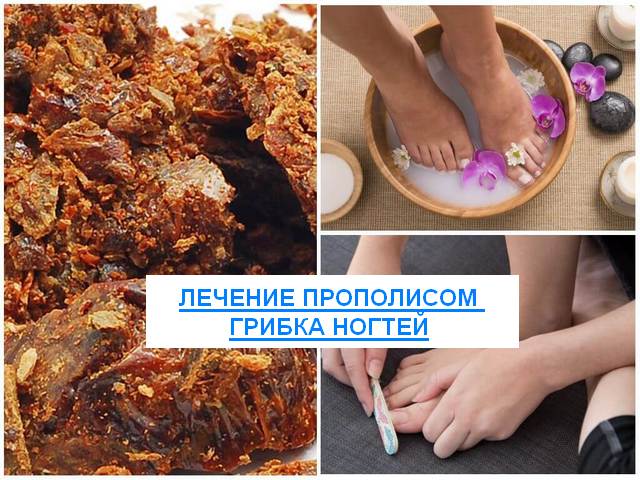 Лечение грибка ногтей прополисом. прополис от грибка ногтей.