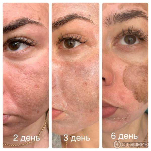 Пилинги для лица: виды (профессиональные и домашние), как выбрать