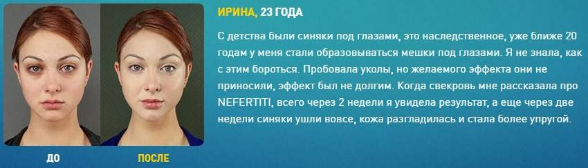 Хронические синяки и темные круги под глазами: как бороться?