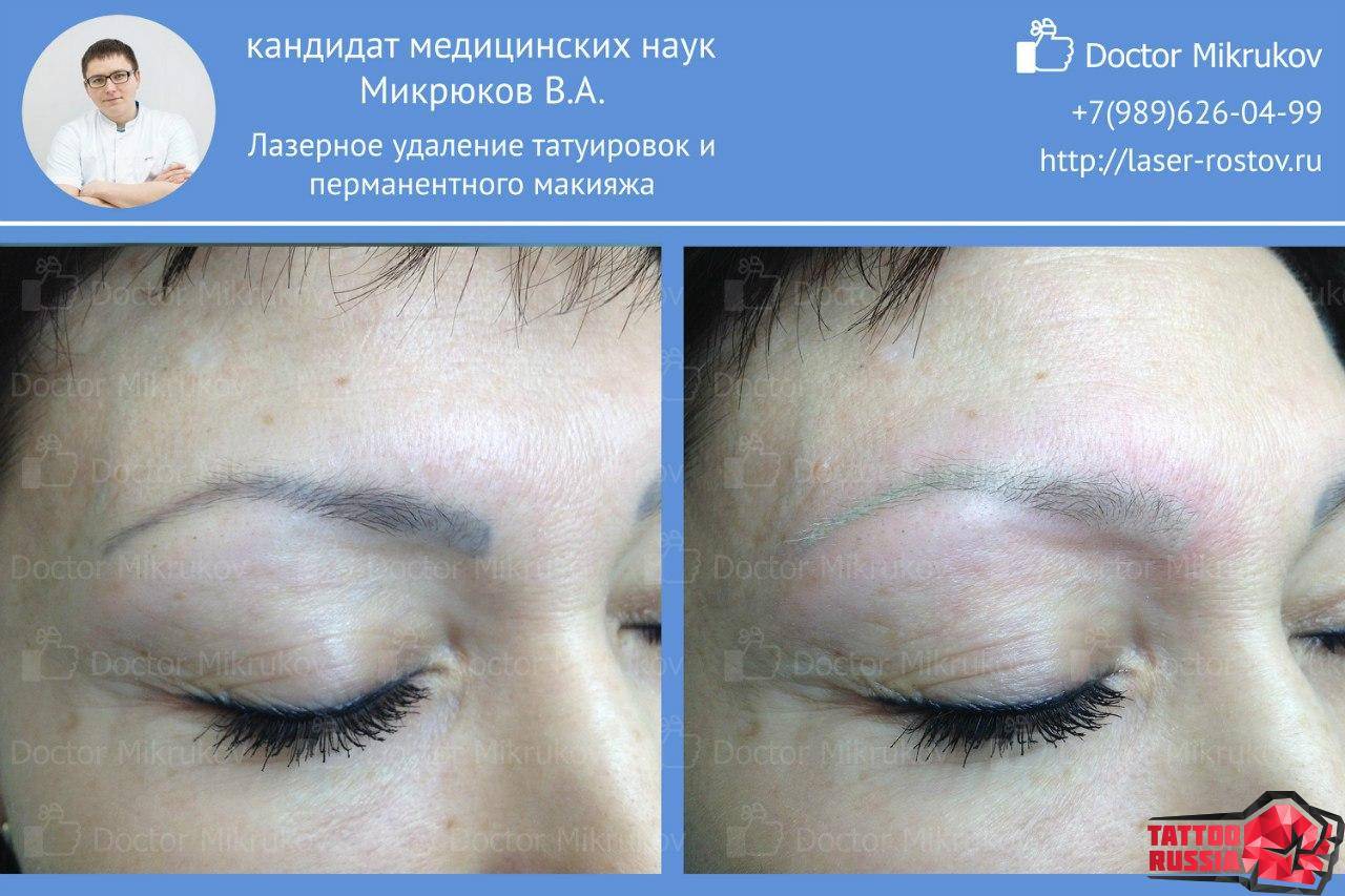Как быстро удалить растушевка брови домашних условиях. как убрать неудачный татуаж бровей?