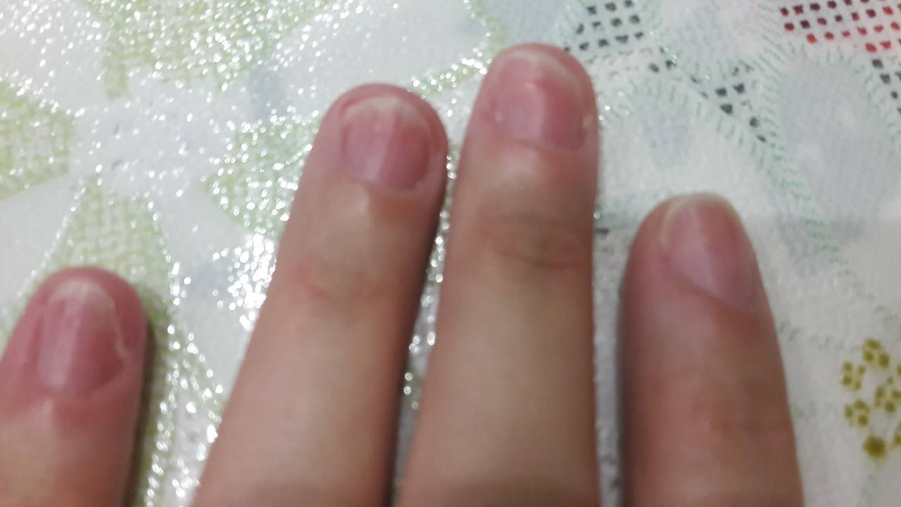 Дистрофия ногтя как лечить народными средствами - profilaktika24.ru
