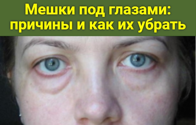 Мешки под глазами: причины и решение