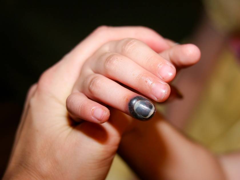 Ушиб ногтя на ноге или руке: что делать, как лечить и надо ли к врачу