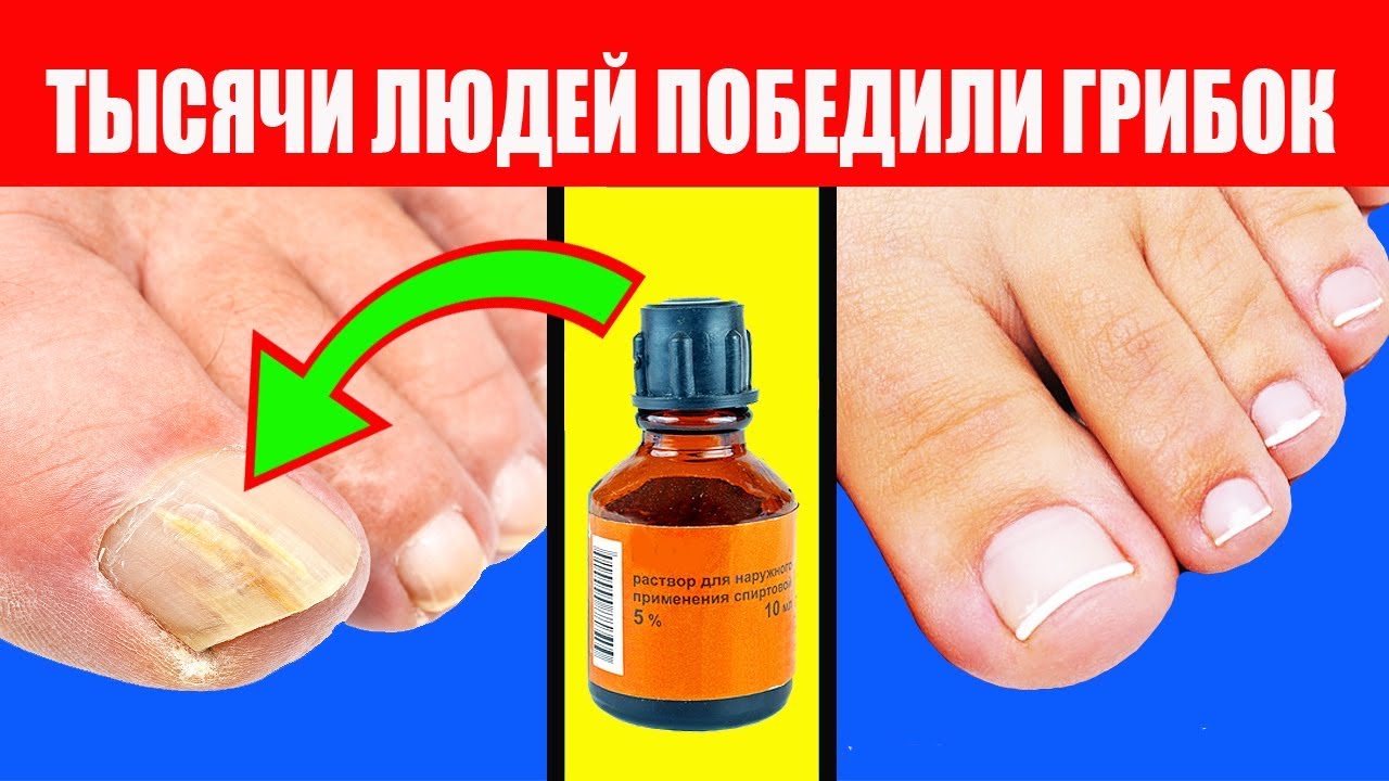 Онихомикоз ногтей: фото, лечение недорогими но эффективными препаратами