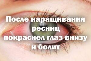 Аллергия на нарощенные ресницы: причины, симптомы, рекомендации