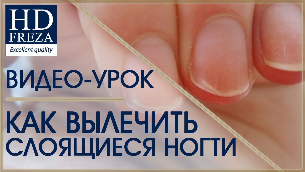 Слоятся ногти — что делать? причины и лечение в домашних условиях