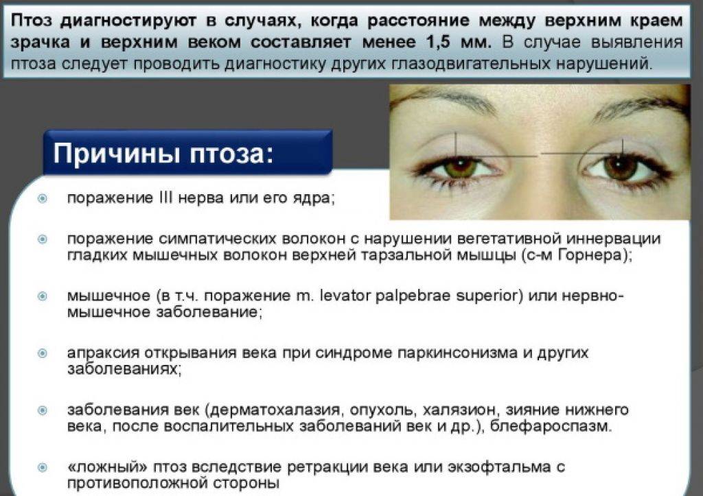 Птоз верхнего века: причины, виды, лечение в домашних условиях и медикаментозное