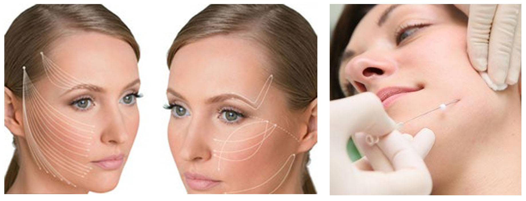 Что такое нитевой лифтинг