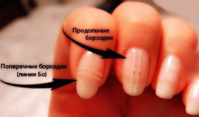 Почему ногти на руках ребристые вдоль и вертикально, с каким заболеванием связано – лечение