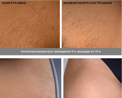 Лазерная эпиляция — противопоказания, последствия, фото до и после