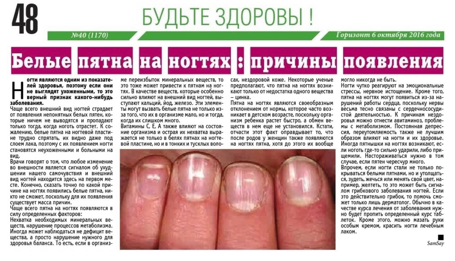 Белые полоски на ногтях: что означают, причины, лечение