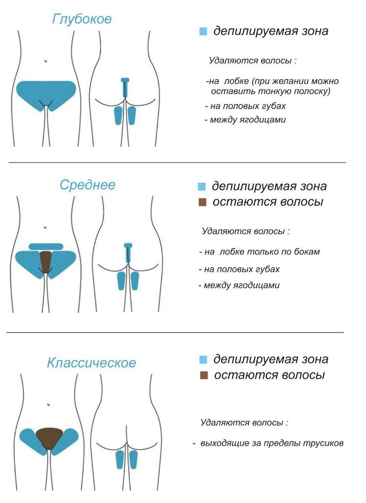 Шугаринг бикини: классическое, глубокое, бразильское, как выполняется