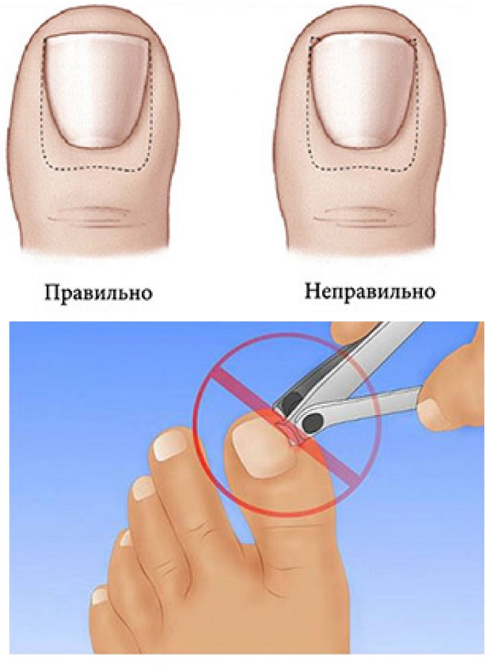 Лечение после удаления вросшего ногтя
