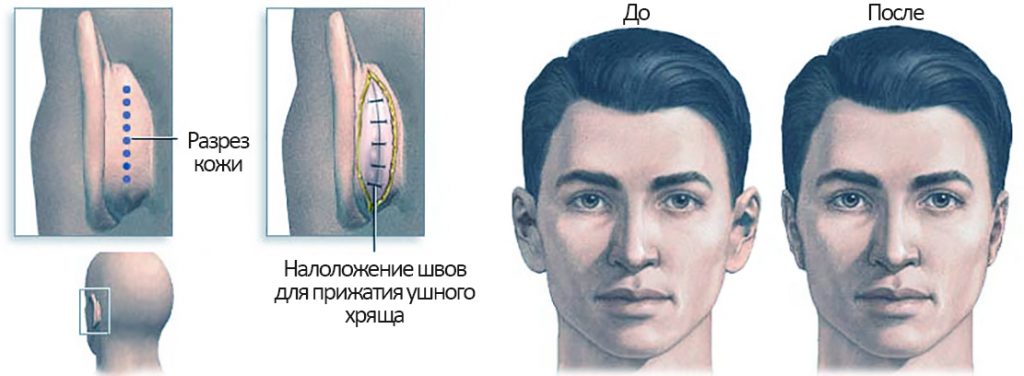 Отопластика: показания, противопоказания, фото до/после