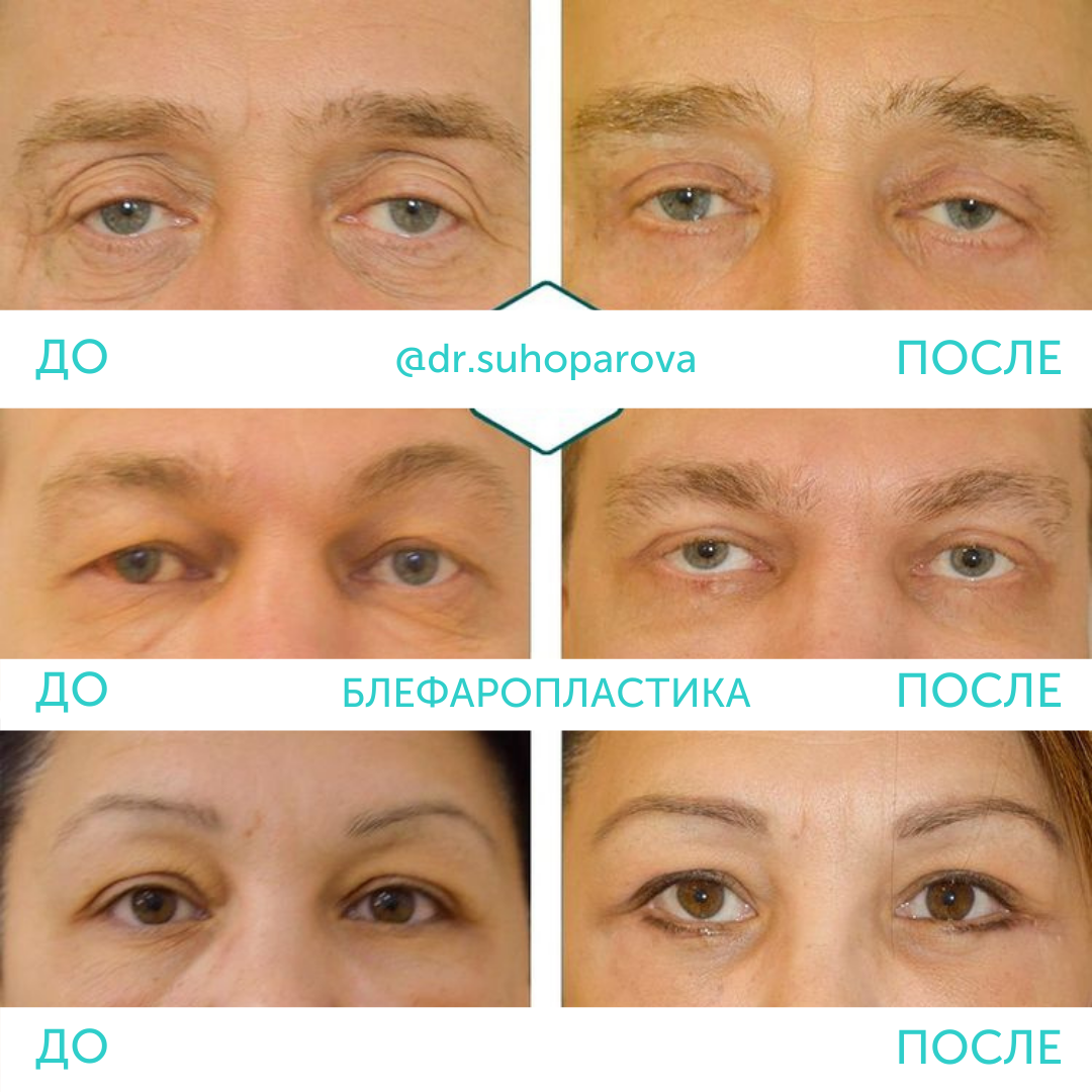 Кантопексия: что это, фото до и после