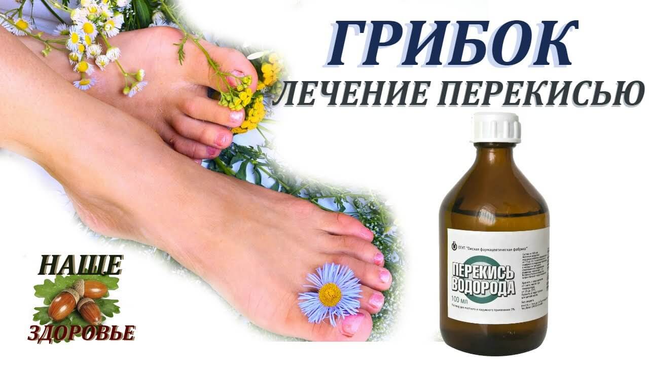 Чем лечить грибок ногтей на руках в домашних условиях: топ-20 рецептов