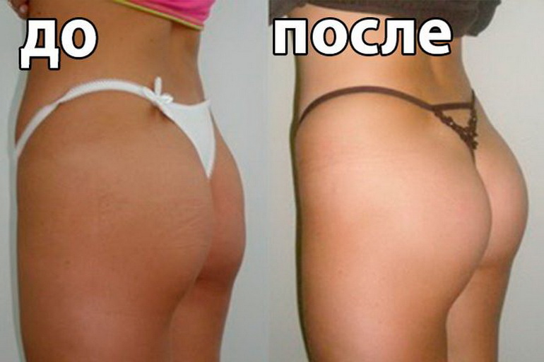 Глютеопластика (пластика ягодиц)